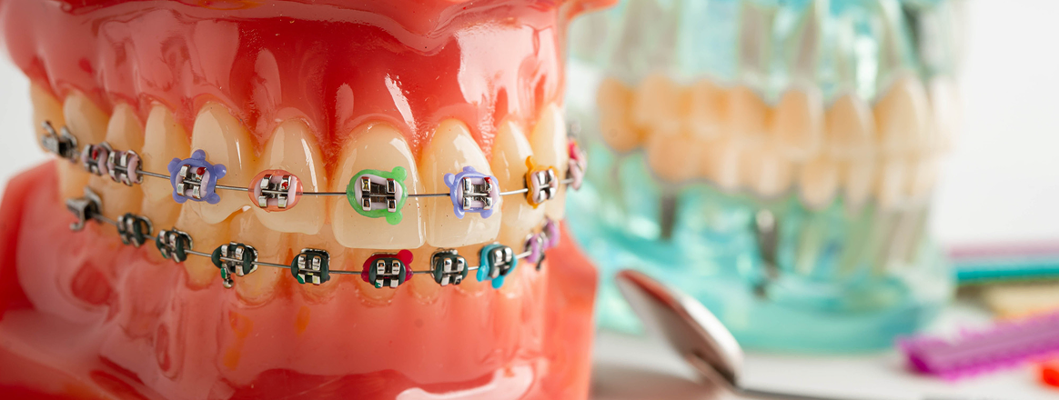 ワイヤー矯正の模型